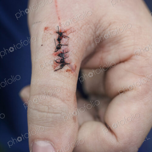 Close-up of an injured left thumb with stitches on the wound. Close-up of an injured left thumb with stitches on the wound.