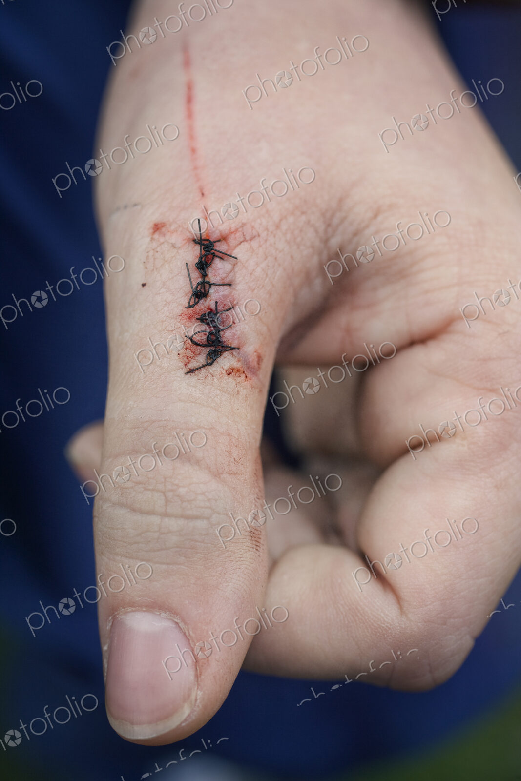 Close-up of an injured left thumb with stitches on the wound.